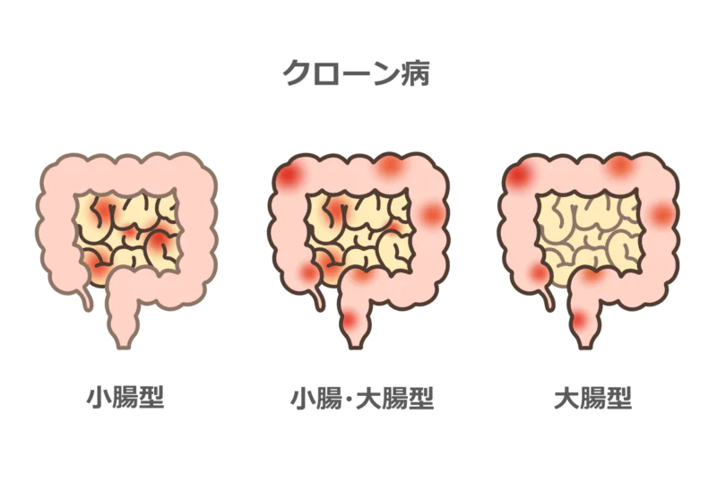 クローン病