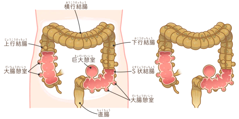 大腸憩室省