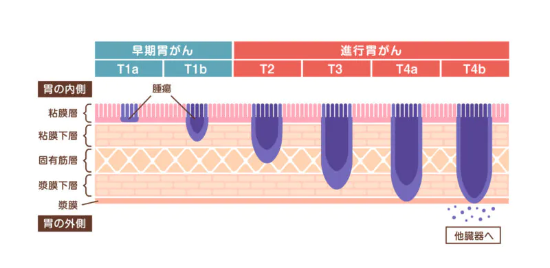 胃がん