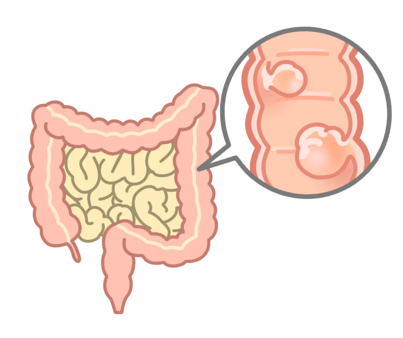 大腸ポリープ