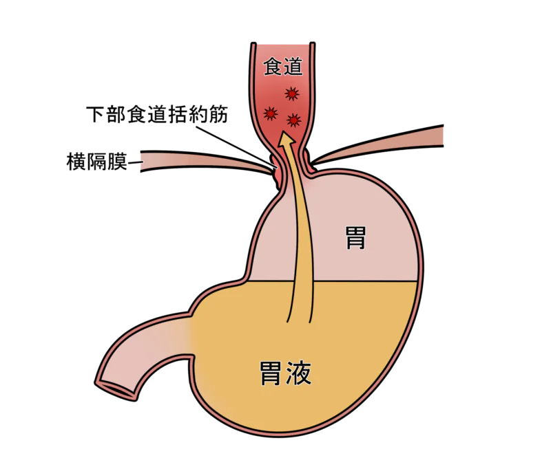 逆流性食道炎